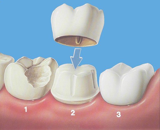 Cách chăm sóc răng sứ thẩm mỹ