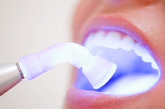Tẩy trắng răng Laser Whitening có là tốt nhất?