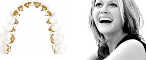 Các loại mắc cài niềng răng