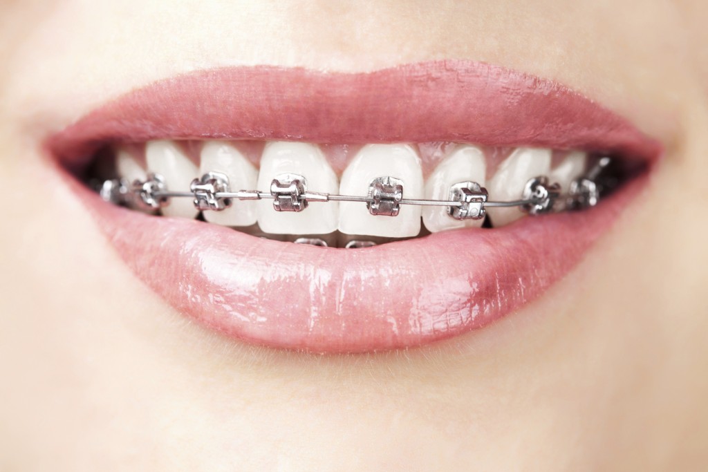 Quy trình niềng răng mắc cài kim loại như thế nào ?