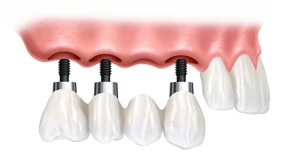 Bị mất nhiều răng có cần cấy ghép nhiều trụ implant? 