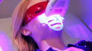 Tẩy trắng răng bằng đèn plasma có hại không