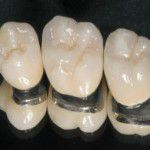 răng sứ kim loại thường