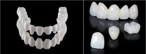Quy trình và ưu điểm của bọc răng sứ Venus