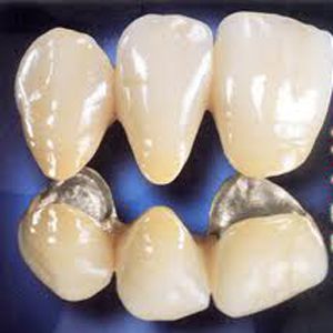 Tìm hiểu sâu hơn về răng sứ titan