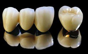 Răng sứ titan có tốt đối với cơ thể con người