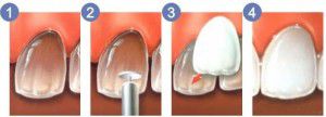 Trường hợp nào nên dán mặt răng sứ veneer