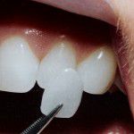 Bọc răng sứ Veneer