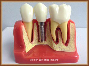 Cấy ghép răng implant