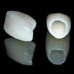 Răng sứ venus bảo tồn được bao lâu ?