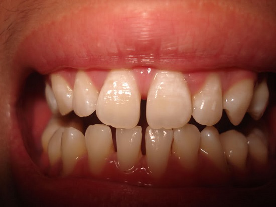 Răng sứ Veneer mặt dán sứ thẩm mỹ cao cấp-2