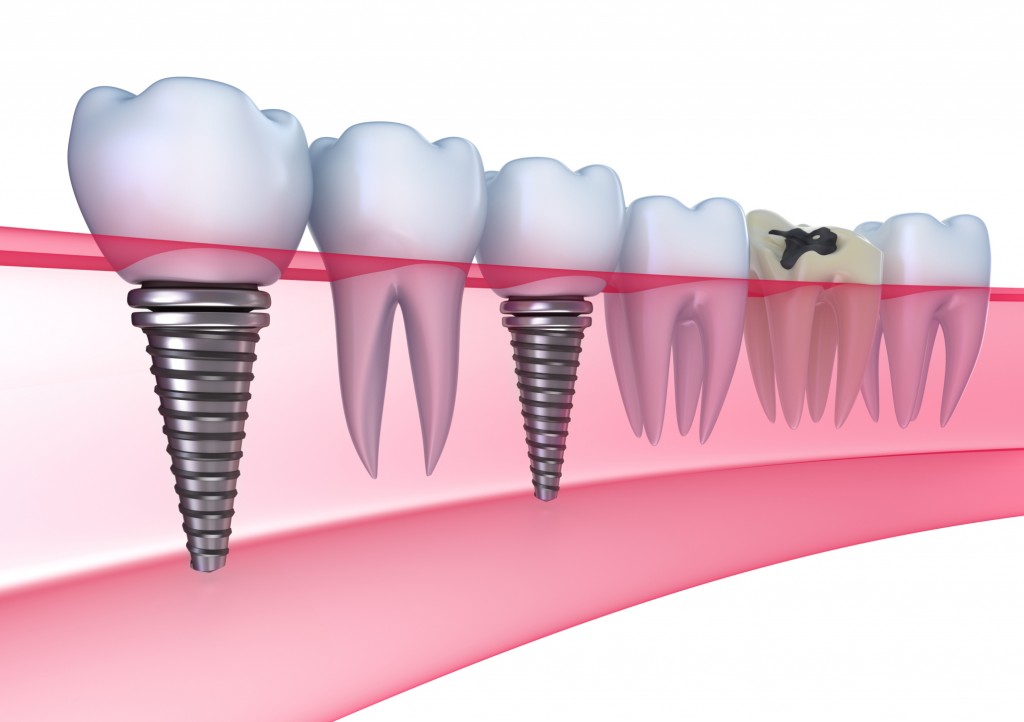 Chăm sóc răng implant hiệu quả ?