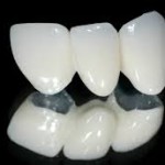 Có nên bọc răng sứ cho răng khấp khểnh