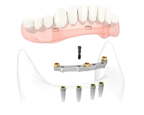 Lựa chọn cấy ghép implant 4S để trồng răng 2