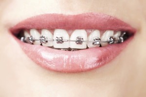 Niềng răng cố định là gì ?