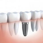 Cấy ghép implant có ảnh hưởng đến xương hàm ?