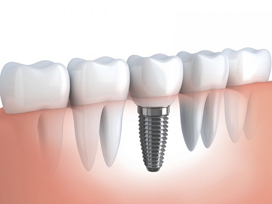 Cấy ghép implant gắn răng liền 1
