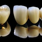 Bọc răng sứ nào tốt ?
