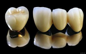 Bọc răng sứ nào tốt ?