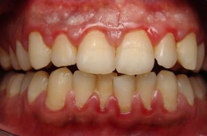 Bị viêm chân răng điều trị như thế nào cho hiệu quả? 1