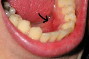 Viêm chân răng có mủ phải điều trị như thế nào? 1