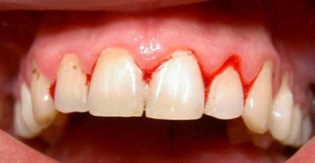 Viêm chân răng có nguy hiểm không? 1