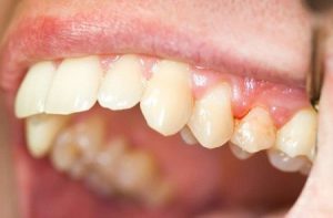 Viêm lợi hở chân răng do đâu? 1