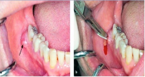 Áp xe răng khôn là gì? Tại sao cần điều trị áp xe răng khôn? 3