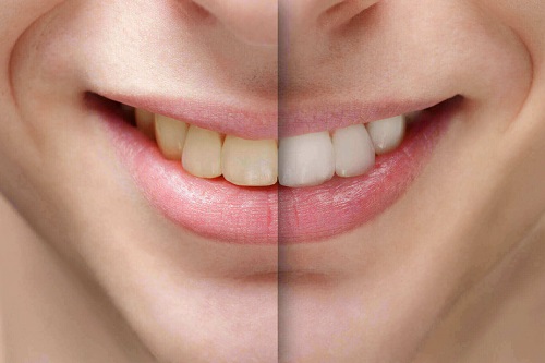 Tác hại của việc tẩy trắng răng gây ảnh hưởng gì cho bạn 1