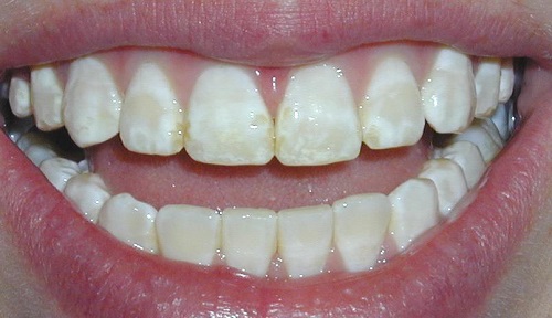 Tác hại của việc tẩy trắng răng gây ảnh hưởng gì cho bạn 2