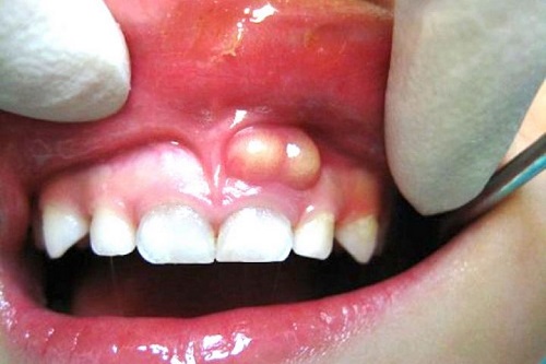 Áp xe răng ở trẻ em dưới 15 tuổi phụ huynh cần lưu ý gì? 1