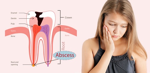 Áp xe răng ở trẻ em dưới 15 tuổi phụ huynh cần lưu ý gì? 2