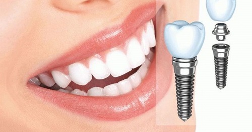 Cấy ghép răng implant có tốt không? 2