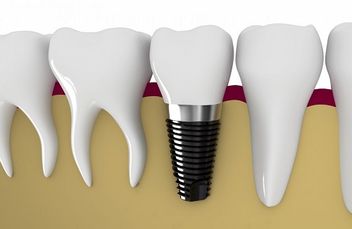 Cách chăm sóc răng sau khi cấy implant cho bạn 1