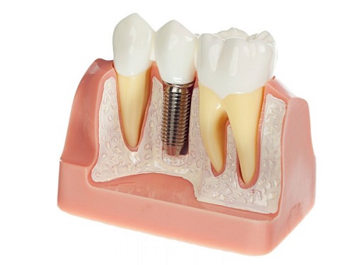 Địa chỉ trồng răng implant tốt nhất ở đâu? 1