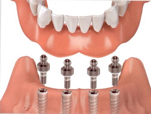 Địa chỉ trồng răng implant tốt nhất ở đâu? 2