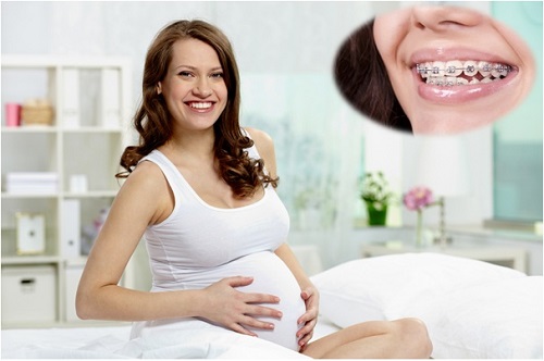 Kết quả hình ảnh cho niềng răng khi mang thai