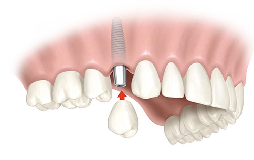 Thời gian cấy ghép răng implant trong bao lâu? 1