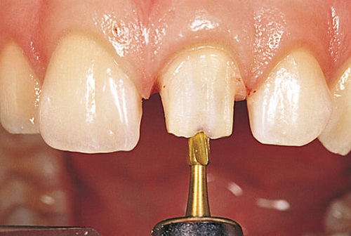 Làm răng sứ có đau không? Chia sẻ từ khách hàng-2