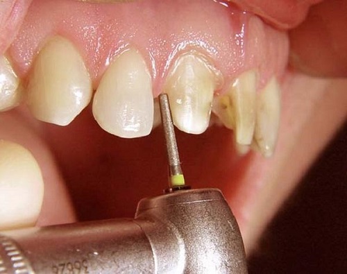 Làm răng sứ sau bao lâu thì hết ê buốt? Cách xử lý hiệu quả-2