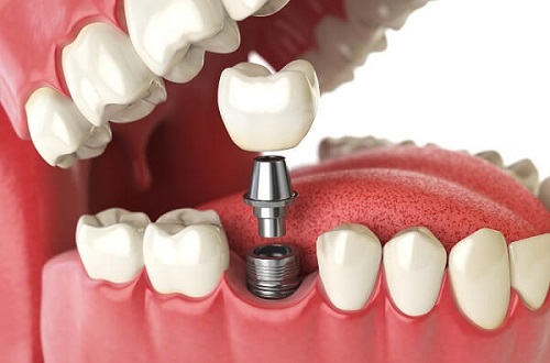 Trồng răng implant ở Cần Thơ an toàn hiệu quả cao-1
