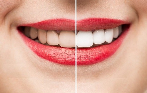 Tẩy trắng răng xong có được đánh răng không? Đâu là câu trả lời đúng 1