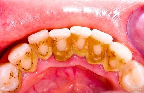 Lấy cao răng có ảnh hưởng gì không? Tìm hiểu cách chăm sóc răng 2