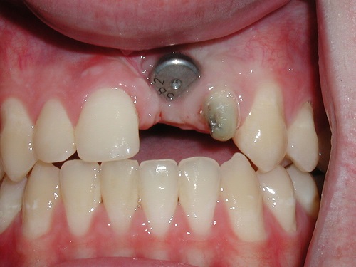 Trồng răng cửa hàm trên - Kỹ thuật phục hình phù hợp 1