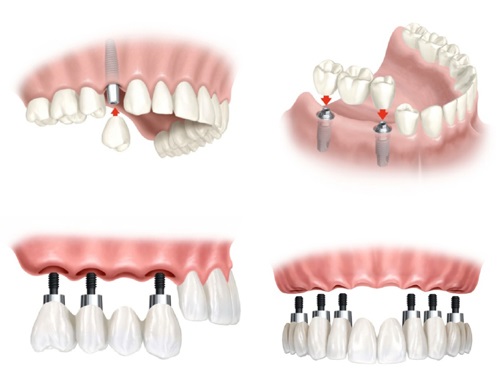 Làm răng implant ở đâu tốt tại TPHCM? 2
