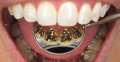 Niềng răng mặt trong mất bao lâu để được hàm răng đều? 1
