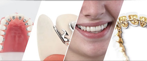 Niềng răng mặt trong mất bao lâu để được hàm răng đều? 2