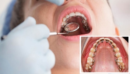 Niềng răng mặt trong mất bao lâu để được hàm răng đều? 3