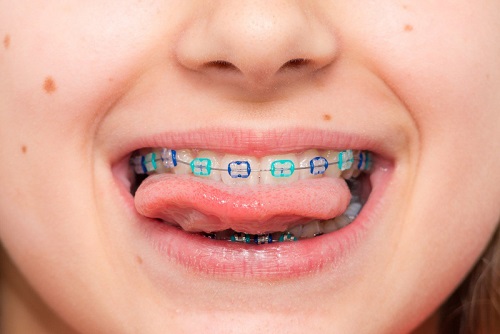 Niềng răng cho trẻ 10 tuổi - Tìm hiểu ngay 1