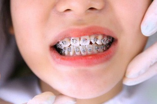 Niềng răng cho trẻ 10 tuổi - Tìm hiểu ngay 2